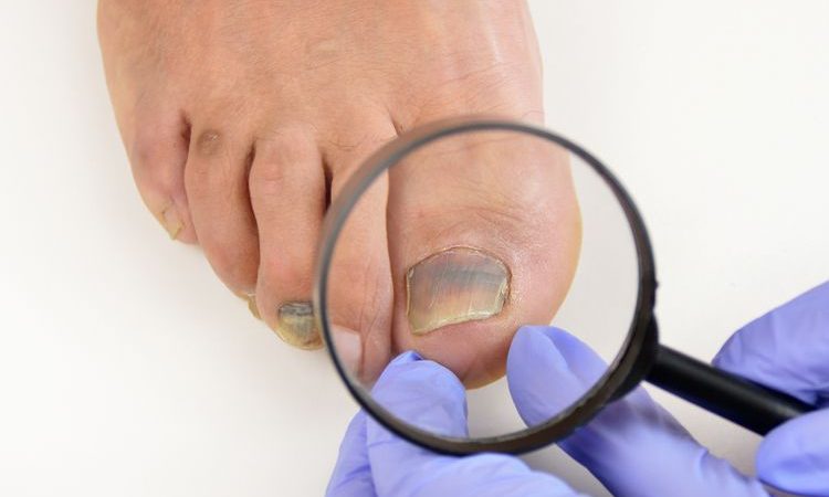 13 Ciri-ciri Kuku Tidak Sehat Yang Bisa Menjadi Tanda Penyakit