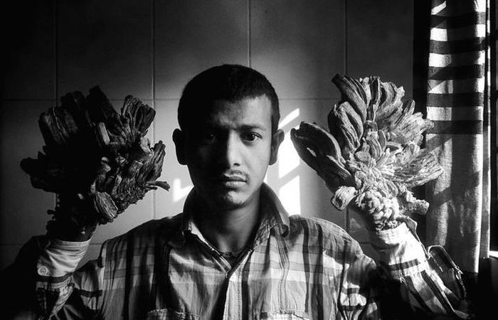 7 Penyakit Teraneh Dan Langka Di Dunia