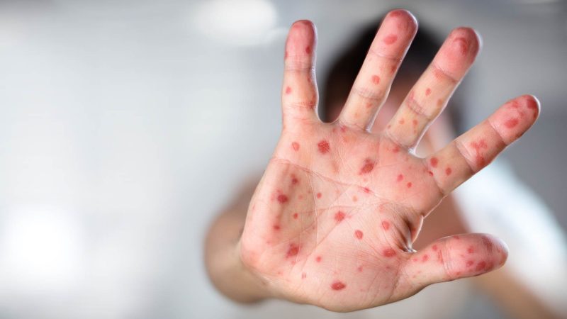 Mengenal Flu Dari Singapura