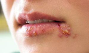 Understanding the Herpes Virus