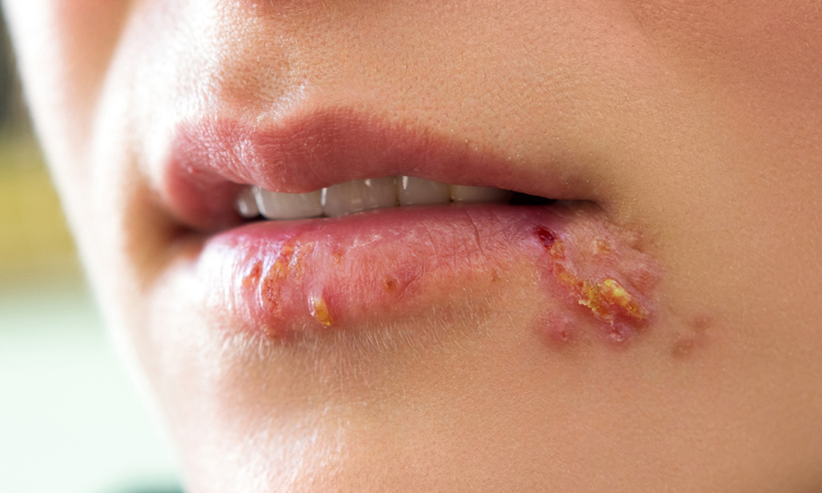 Understanding the Herpes Virus